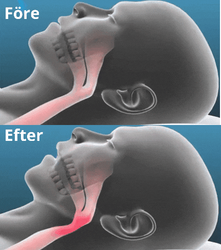 ⁠SnoreStop® | Professionel anti-snorke bettskena⁠
